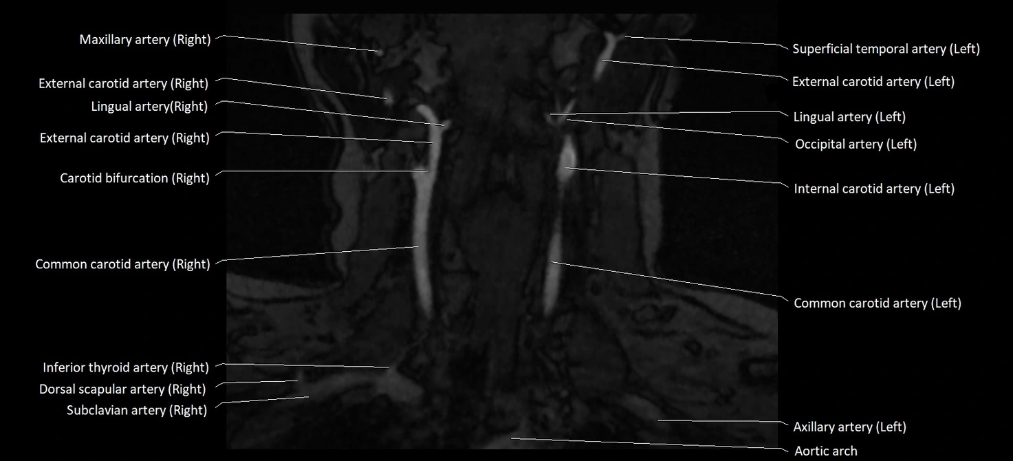 MRA carotid artery anatomy cross sectional 3T coronal image 6.webp
